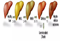谈肝色变肝病NASH的探索之路