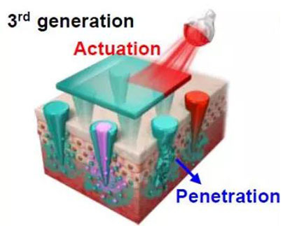 第三代：通过微针介导的皮肤层破坏和微针伴随的各种功能增强药物转运.jpg
